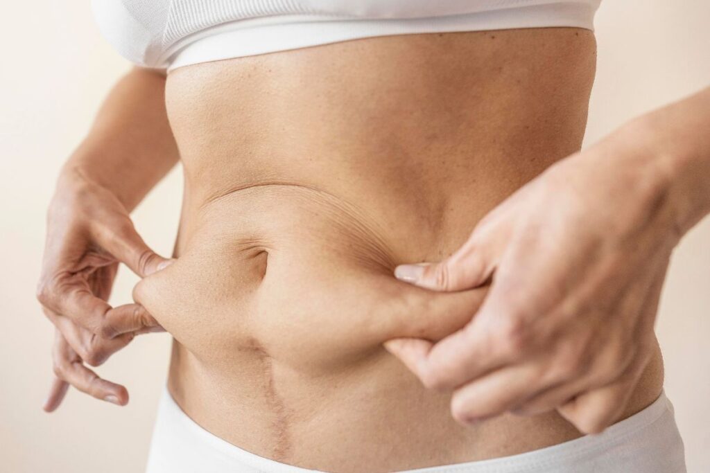 abdominoplastia