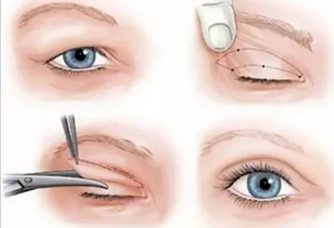 blefaroplastia