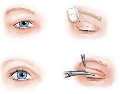 Braquioplastia

Lifitng de coxas

Flancotorsoplastia

Abdominoplastia em ancora

gluteoplastia