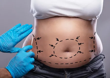 abdominoplastia