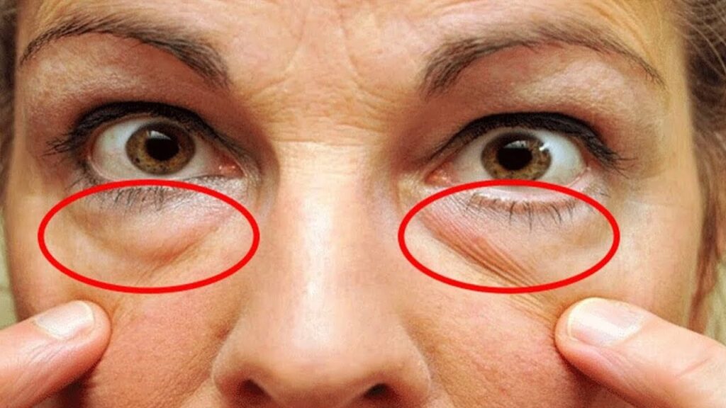 blefaroplastia